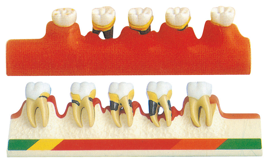 Periodontal Ziektemodel omvat 5 Delen voor Tandscholen Opleiding