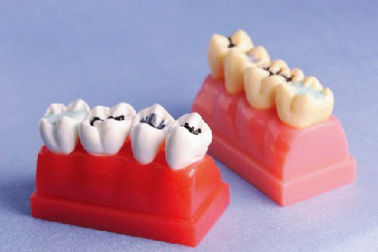Menselijk Tandenmodel voor Dichtingsproduct en Inlegseldemonstratiemodel van 4 Keer Levensgroot