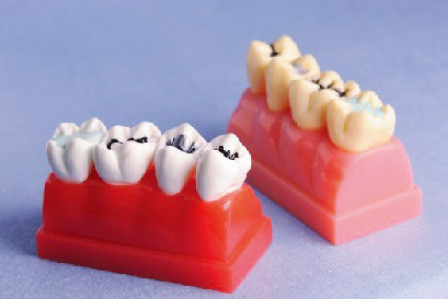 Menselijk Tandenmodel voor Dichtingsproduct en Inlegseldemonstratiemodel van 4 Keer Levensgroot